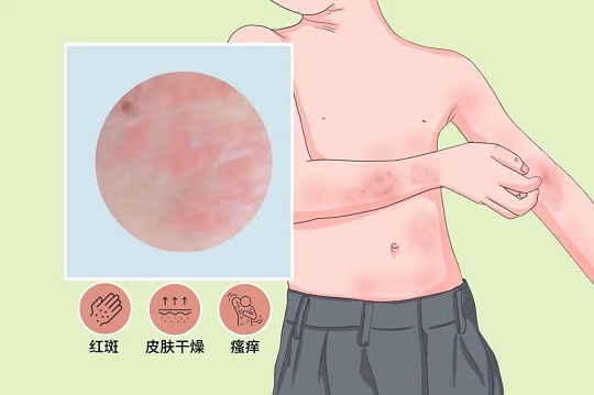 干細胞治療皮炎
