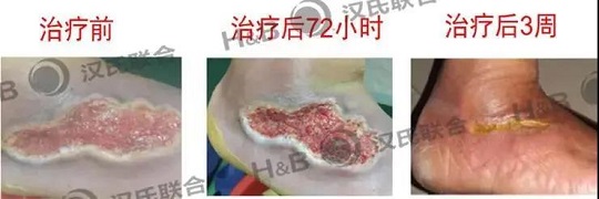 糖尿病足治療