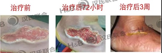 漢氏聯合干細胞治療糖尿病足