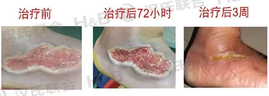 糖尿病治療選漢氏聯合